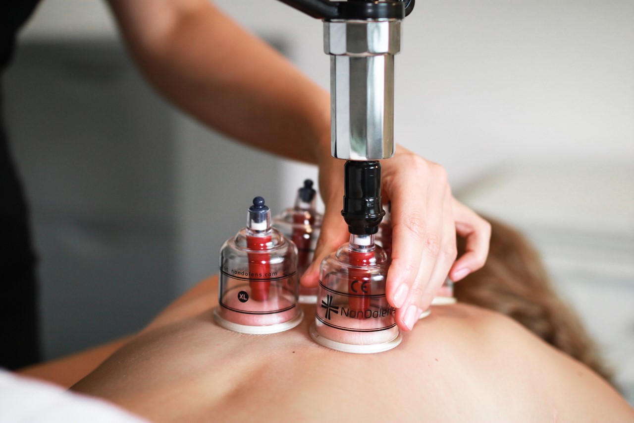 Cupping 2